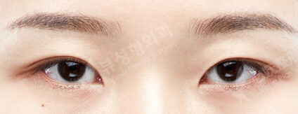 Lower Canthoplasty (3 Months) — Before