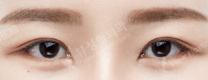 Lower Canthoplasty (3 Months) — After