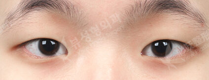 Double Eyelid Surgery+Ptosis Correction+Epicanthoplasty (3 Months) — Before