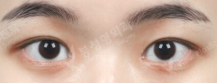 Double Eyelid Surgery+Ptosis Correction+Epicanthoplasty (3 Months) — After