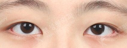 Double Eyelid+Ptosis Correction (3 Months) — Before