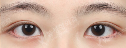 Double Eyelid+Ptosis Correction (3 Months) — After