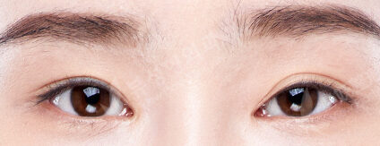 3 Types Face Contouring ++ Incisional Double Eyelid Surgery (Ptosis Correction+Lateral Canthoplasty+Lower Canthoplasty)(6 Months) — Before