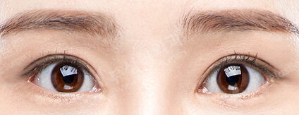 3 Types Face Contouring ++ Incisional Double Eyelid Surgery (Ptosis Correction+Lateral Canthoplasty+Lower Canthoplasty)(6 Months) — After