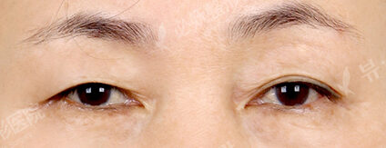 Upper Blepharoplasty+Lower Blepharoplasty (8 Months ) — Before