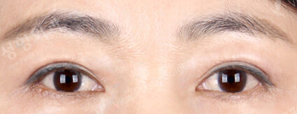 Upper Blepharoplasty+Lower Blepharoplasty (8 Months ) — After