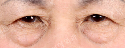 Upper Blepharoplasty+Lower Blepharoplasty (11 Months ) — Before