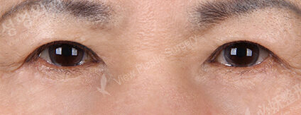 Upper Blepharoplasty+Lower Blepharoplasty (11 Months ) — After