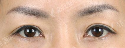 Sub-Brow Lift (6 Months ) — Before
