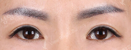 Sub-Brow Lift (6 Months ) — After