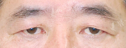 Lower Blepharoplasty (3 Months ) — Before