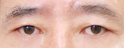 Lower Blepharoplasty (3 Months ) — After