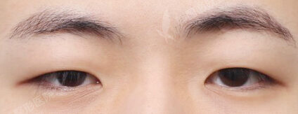 Incisional Ptosis Correction+Epicanthoplasty (3 Months) — Before