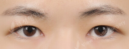 Incisional Ptosis Correction+Epicanthoplasty (3 Months) — After