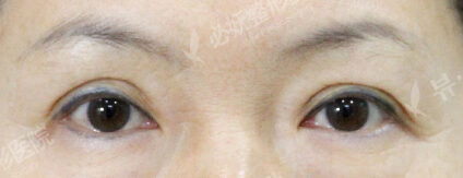 Lower Blepharoplasty (1 Months ) — Before