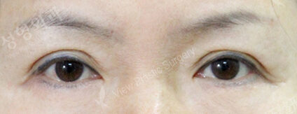 Lower Blepharoplasty (1 Months ) — After