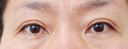 Transconjuntival fat removal (3 Months) — Before