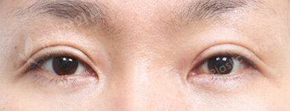Transconjuntival fat removal (3 Months) — After