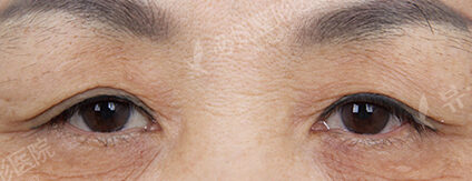 Upper Blepharoplasty+Lower Blepharoplasty (2 Months ) — Before
