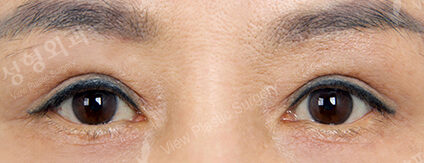 Upper Blepharoplasty+Lower Blepharoplasty (2 Months ) — After