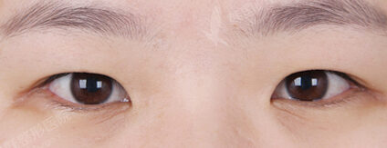 Combination Ptosis Correction Surgery+Upper Blepharoplasty+Epicanthoplasty (3 Months) — Before