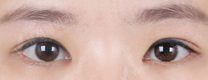 Combination Ptosis Correction Surgery+Upper Blepharoplasty+Epicanthoplasty (3 Months) — After