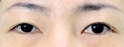 Transconjuntival fat removal (1 Months ) — Before