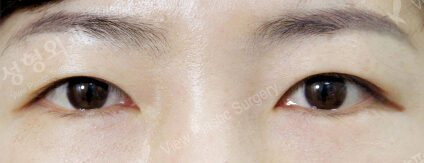 Transconjuntival fat removal (1 Months ) — After