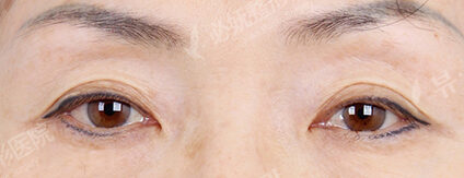 Ptosis Correction (5 Months ) — Before