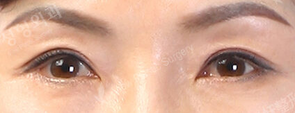Ptosis Correction (5 Months ) — After