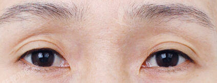 Partial Ptosis Correction Surgery+Lateral Canthoplasty+Lower Canthoplasty (4 Months) — Before