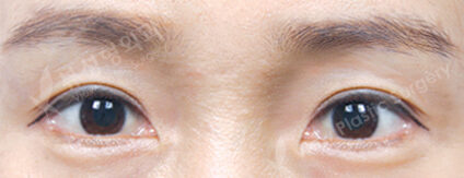 Partial Ptosis Correction Surgery+Lateral Canthoplasty+Lower Canthoplasty (4 Months) — After