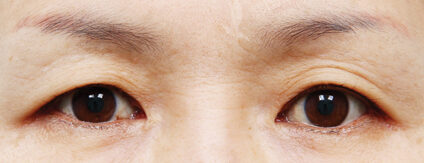 Fat Graft+Upper Blepharoplasty (3 Months) — Before