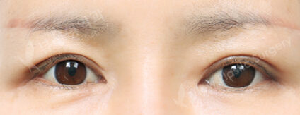 Fat Graft+Upper Blepharoplasty (3 Months) — After