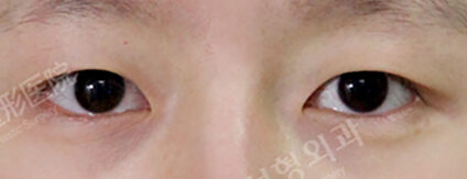 Fat Graft+Magic Epicanthoplasty+Lateral Canthoplasty(3 Months) — Before