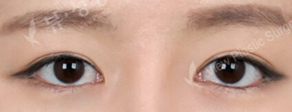 Fat Graft+Magic Epicanthoplasty+Lateral Canthoplasty(3 Months) — After
