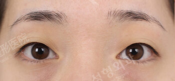 Double Eyelid (Incisional)+ Transconjuntival fat removal(3 Months) — Before