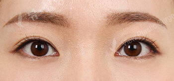Double Eyelid (Incisional)+ Transconjuntival fat removal(3 Months) — After