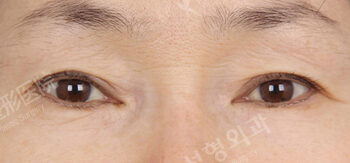Upper Blepharoplasty+Lower Blepharoplasty (1 Months ) — Before