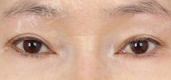 Upper Blepharoplasty+Lower Blepharoplasty (1 Months ) — After