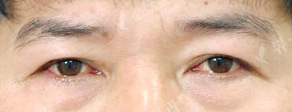 Lower Blepharoplasty (1 Months ) — Before