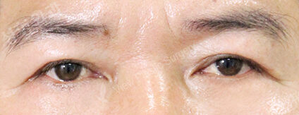 Lower Blepharoplasty (1 Months ) — After