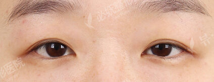 Ptosis Correction+Magic Epicanthoplasty (2 Months ) — Before