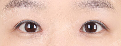 Ptosis Correction+Magic Epicanthoplasty (2 Months ) — After