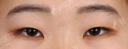 Combination Ptosis Correction Surgery+Magic Epicanthoplasty+Lateral Canthoplasty+Lower Canthoplasty (4 Months ) — Before