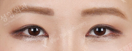 Combination Ptosis Correction Surgery+Magic Epicanthoplasty+Lateral Canthoplasty+Lower Canthoplasty (4 Months ) — After