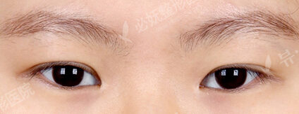 Ptosis Correction+Magic Epicanthoplasty (Revisional Surgery)+ Lateral Canthoplasty (5 Months ) — Before