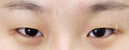 Fat Graft+Magic Epicanthoplasty+Lateral Canthoplasty (1 Months ) — Before