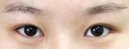 Fat Graft+Magic Epicanthoplasty+Lateral Canthoplasty (1 Months ) — After