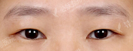 Double Eyelid Surgery (Incisional)+ Lateral Canthoplasty+Lower Canthoplasty (6 Months ) — Before